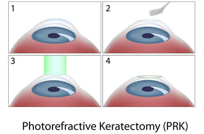 Photorefractive Keratectomy (PRK) steps diagram